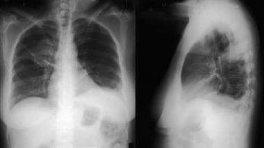 Transient pulmonary infiltrates in a patient with 