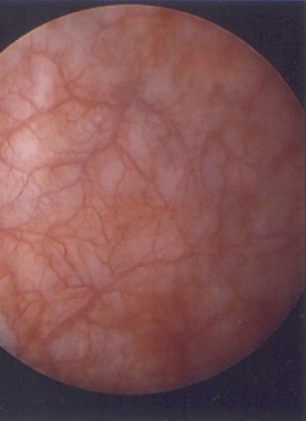 膀胱粘膜的膀胱镜视图显示出s