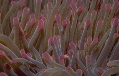 Cnidaria and jellyfish envenomations. Close-up pho