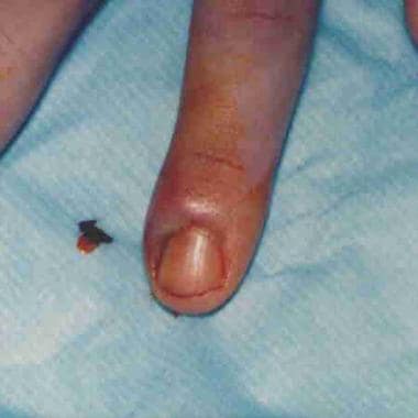 Nail Infection, Fungal (Onychomycosis) Condition, Treatments and Pictures  for Adults - Skinsight