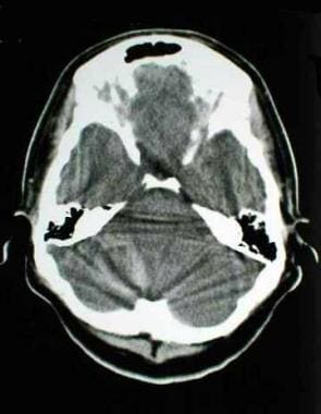 CT scan of a patient with an acute spontaneous cer