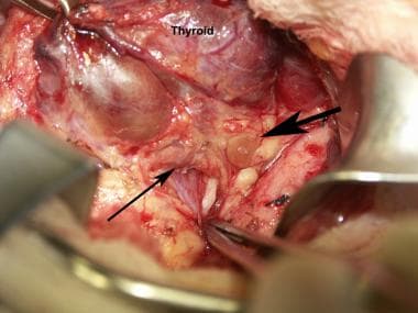 Normal parathyroid glands as seen during a thyroid