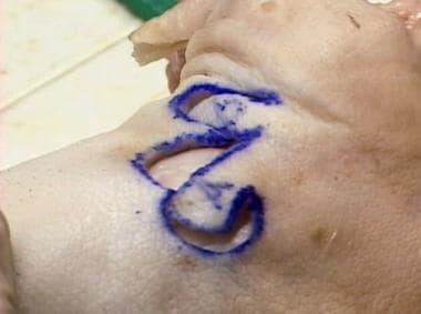 Bilobed flap procedure performed on cadaveric spec