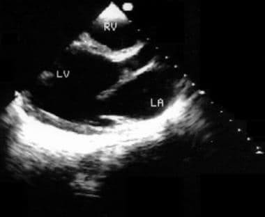 This is an echocardiogram obtained from parasterna