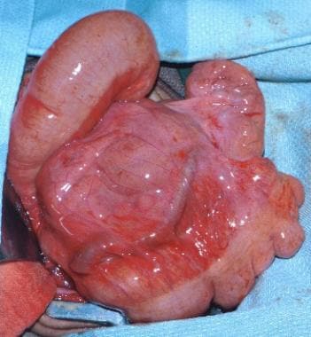 Pediatric Small Bowel Obstruction. This photograph
