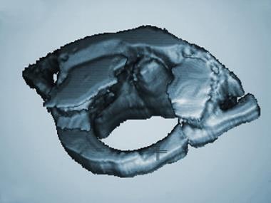 Three-dimensional computed tomography scan of C1. 