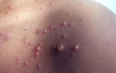 The pleomorphic rash characteristic of varicella. 