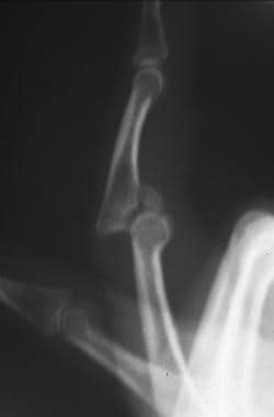 middle phalanx fracture