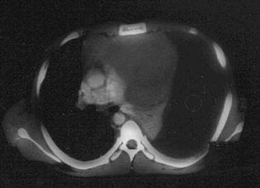 Massive left pleural effusion as a complication of