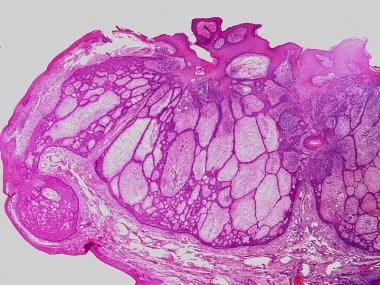 Basal cell fibroepithelioma (Pinkus tumor). Courte