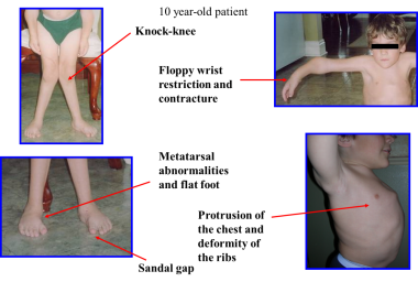 Skeletal/joint problem – hands and legs. This 10-y