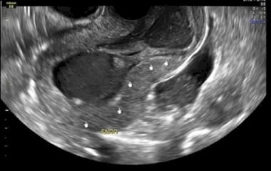 Ultrasound of an adenomyoma dissecting through the