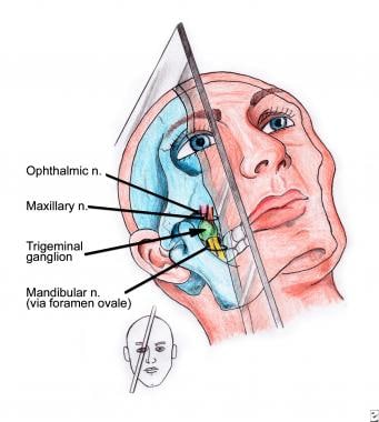 Anatomy and needle-insertion plane of trigeminal g