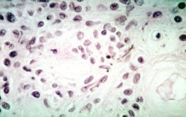 Choroidal melanoma. Histologic section showing spi