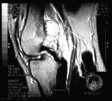 T2-weighted sagittal MRI of a distal femoral perio