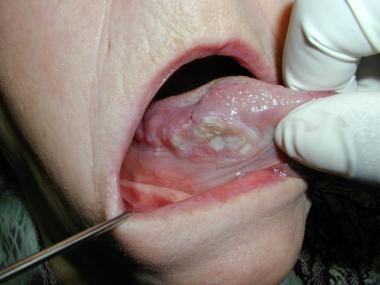 A 63-year-old female presents with tongue discomfo