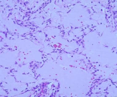 myxoïd leiomyoom met een uitgesproken longoedeem pat