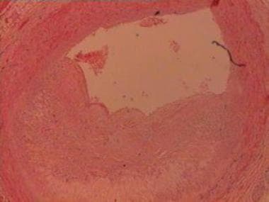 Histologic section of the myocardium showing a cro