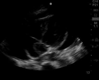 Subxiphoid view of the heart showing a moderate am