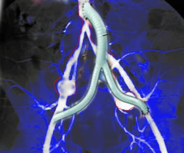 Image shows aorta iliac bypass. 