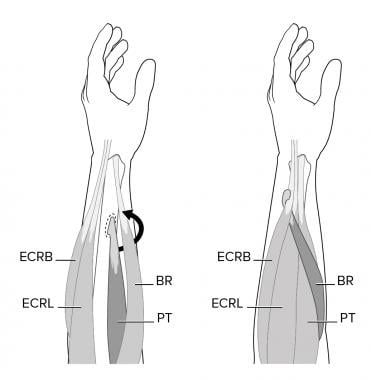 Pronator teres (PT) to extensor carpi radialis bre