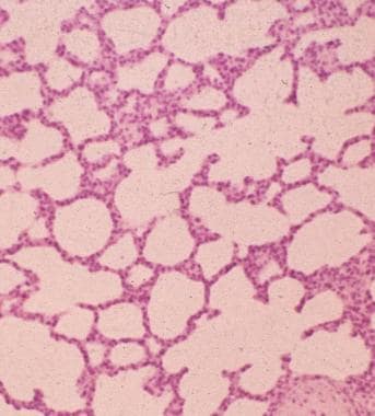 Microscopic picture (hematoxylin and eosin stain) 
