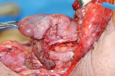 Tongue specimen "pulled through" from oral cavity 