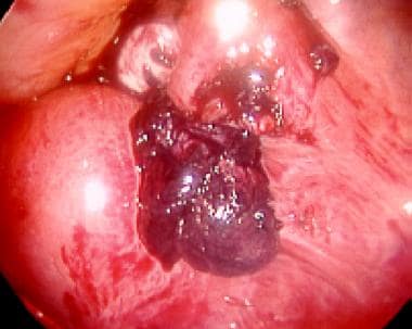 Laparoscopic picture of ampullary ectopic pregnanc
