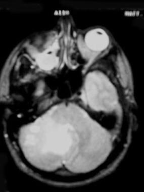 Medulloblastoma. Axial MRI of the posterior fossa 