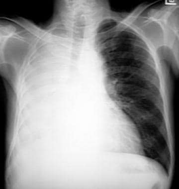 Chest radiograph depicting complete right lung ate