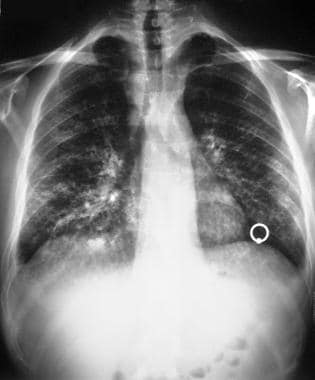 Pulmonary Kaposi Sarcoma Imaging: Practice Essentials, Radiography ...