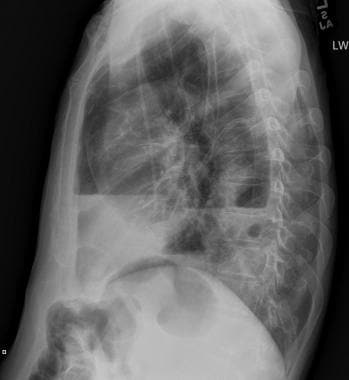 Lateral chest radiograph in a patient with bladder