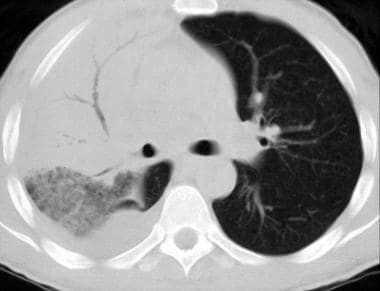 CT scan in a young patient, obtained with the pulm