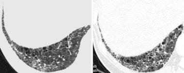 High-resolution CT reveals intralobular interstiti