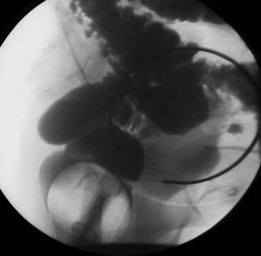 Single-contrast barium enema study demonstrates si