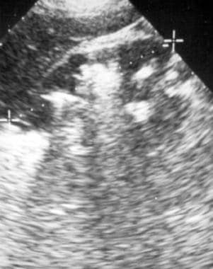 Ultrasonogram of the right kidney in a 52-year-old