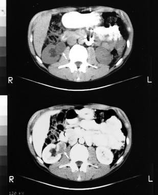 Nonenhanced (top) and enhanced (bottom) CT scans t