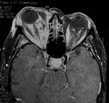 MRI axial section of the orbit. Note the enlargeme