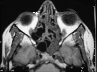 Bilateral ethmoid sinusitis on an MRI. 