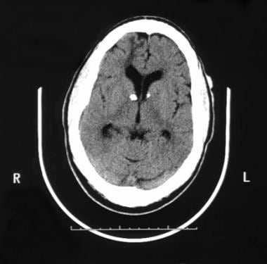 Axial nonenhanced CT image in a patient with tuber