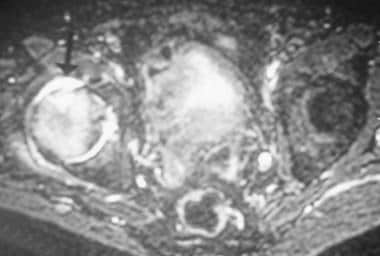 Axial fat-saturated T2-weighted magnetic resonance