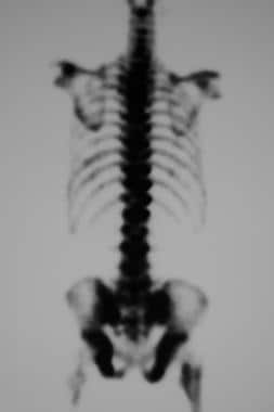 Posterior technetium-99m bone scintiscan in a 79-y