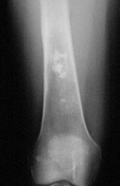 Enchondroma. Radiograph of the right femur demonst