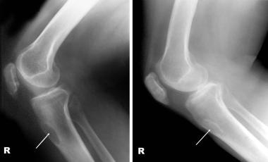 Radiograph in a 53-year-old woman with nutritional