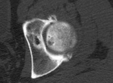 Transverse CT scan image obtained through the supe