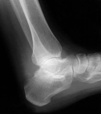 Lateral view of the ankle of a man who presented w