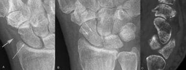 Images show a pseudofracture. The initial radiogra