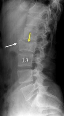 Lumbar spine trauma. Lateral radiograph of an L2 f