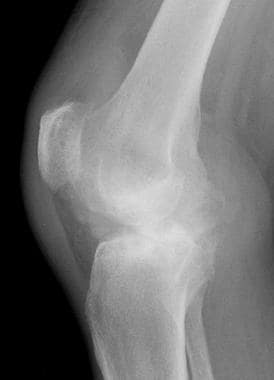 Lateral radiograph from the same patient as in the