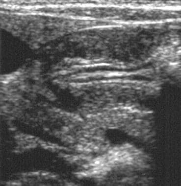 Longitudinal ultrasonogram of the pylorus in a pat